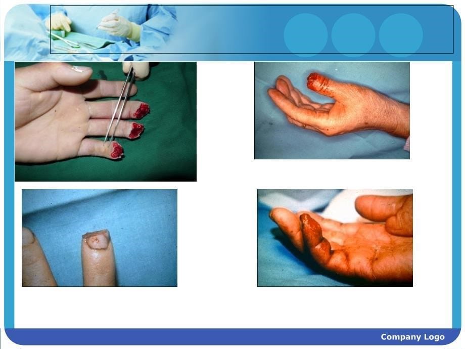 指端损伤的治疗课件_第5页