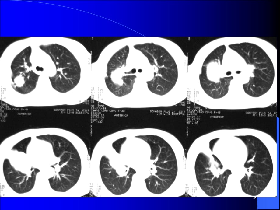 胸部CT阅片及诊断课件PPT_第3页