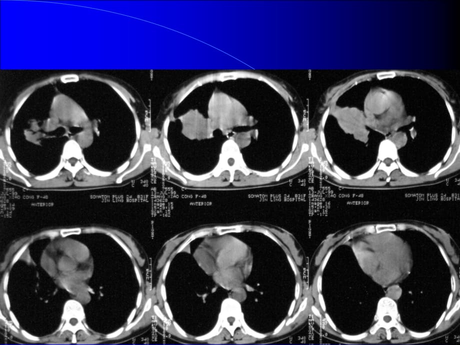 胸部CT阅片及诊断课件PPT_第4页