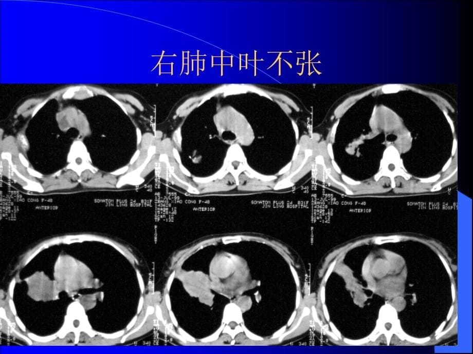 胸部CT阅片及诊断课件PPT_第5页