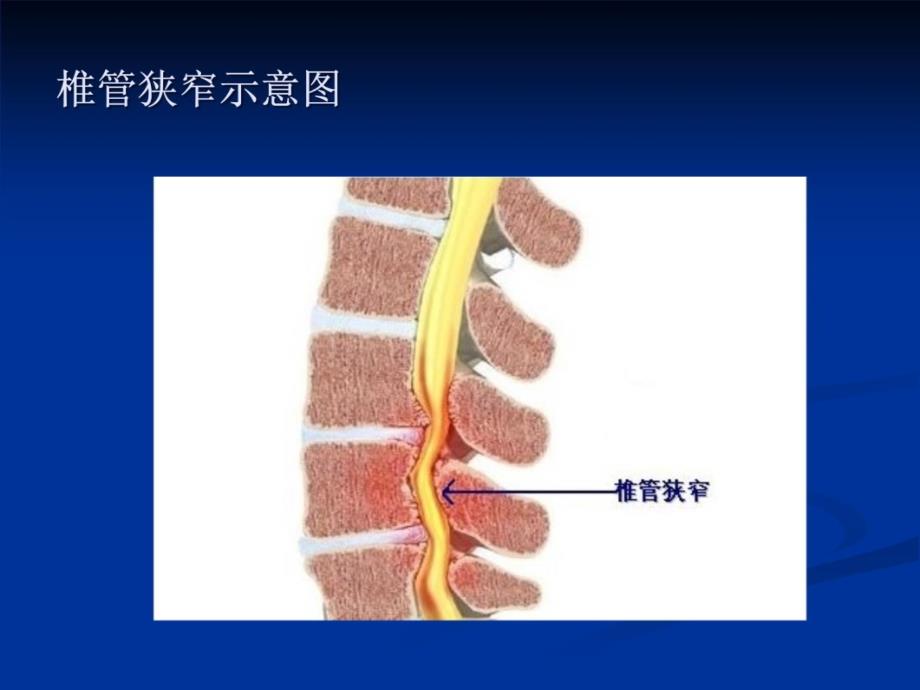 腰椎管狭窄症课件备课讲稿_第3页