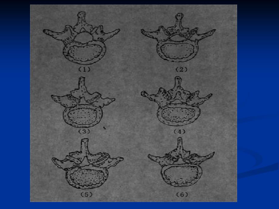 腰椎管狭窄症课件备课讲稿_第4页