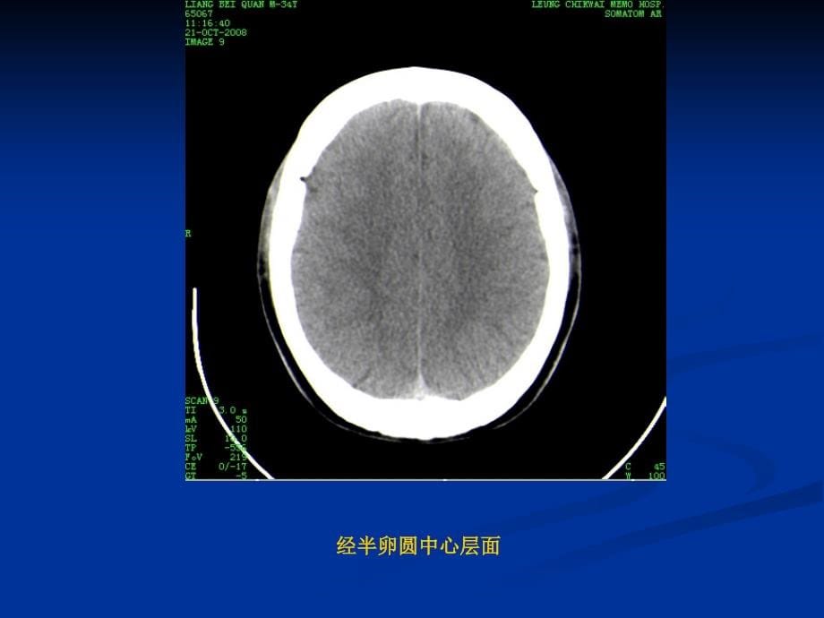 颅脑基本CT征象及颅脑外伤性疾病CT诊断课件PPT_第5页