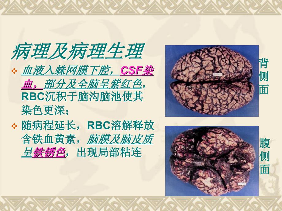 蛛网膜下腔出血1课件PPT_第4页