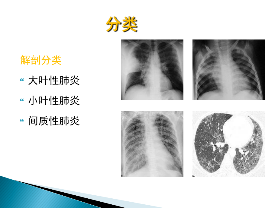内科-肺炎肺脓肿20120301_第3页