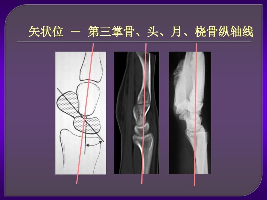 腕关疾病的MRI诊断课件PPT_第5页