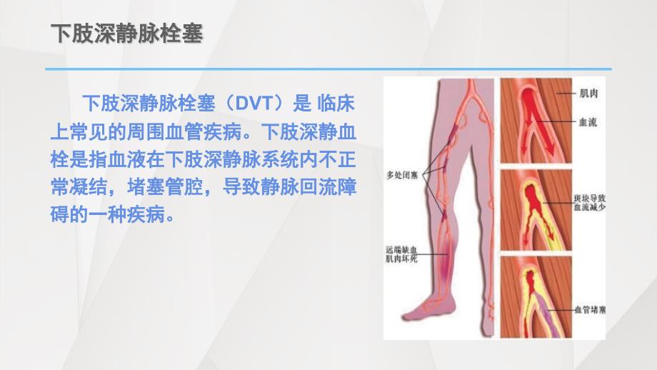 肺栓塞和下肢深静脉栓塞的护理课件PPT_第4页