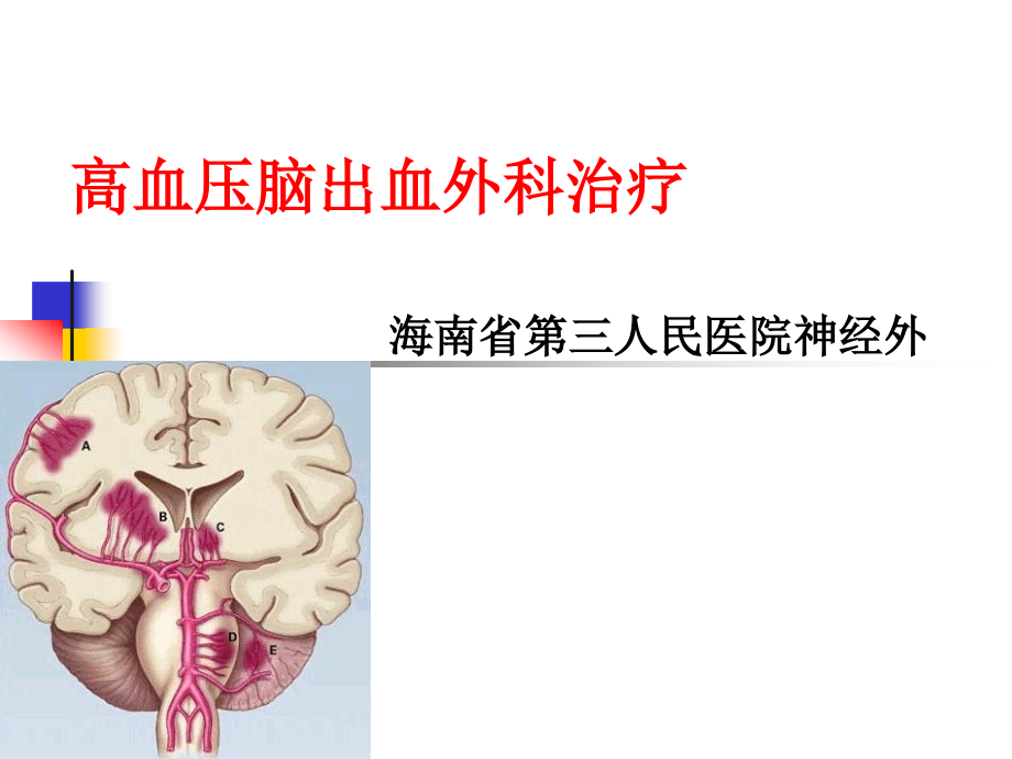 高血压脑出血的外科治疗PPT课件_第1页