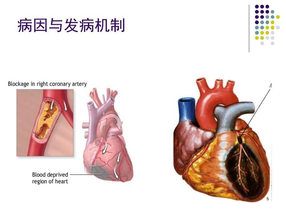 胸痛中心核心科室培训(急性冠脉综合征、主动脉夹层、急性肺栓塞)PPT教学课件_第5页