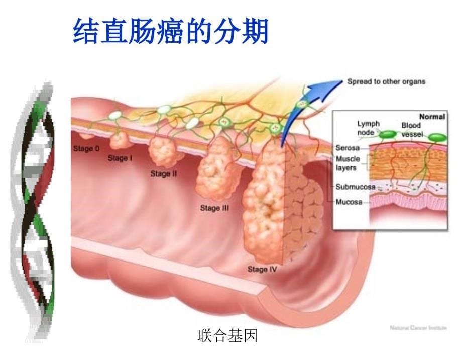 结直肠癌与乳腺癌_第5页