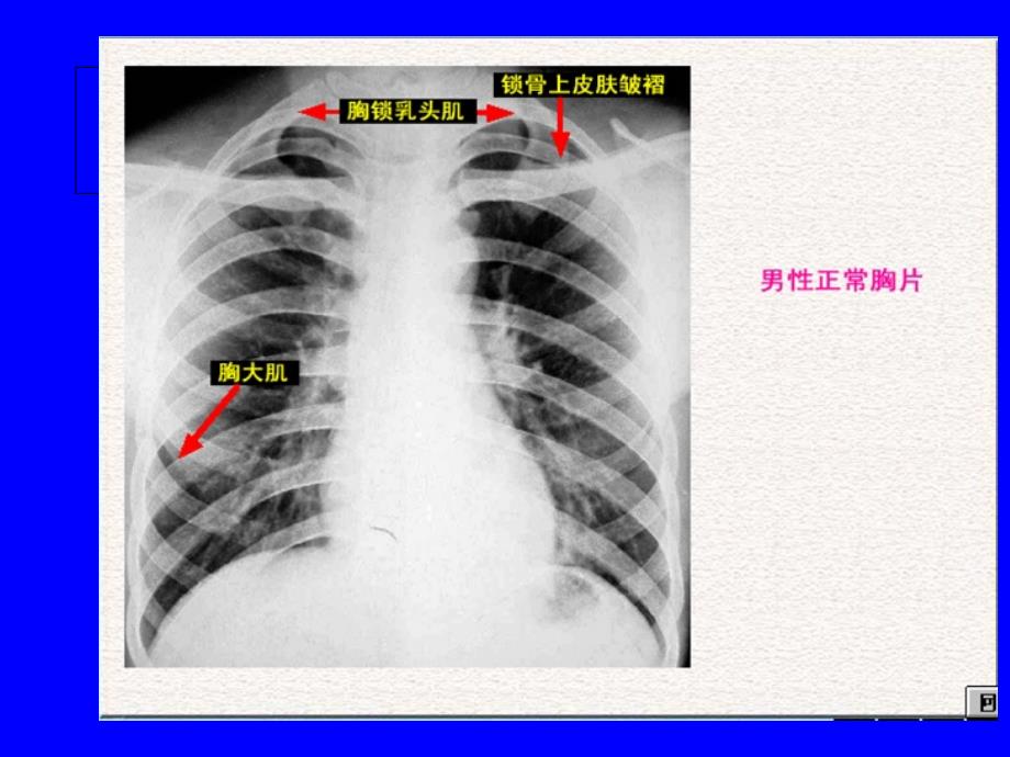 肺部正常和X线异常表现ppt课件_第3页