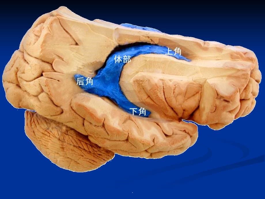 脑室系统解剖及第三脑室手术入路ppt课件_第5页