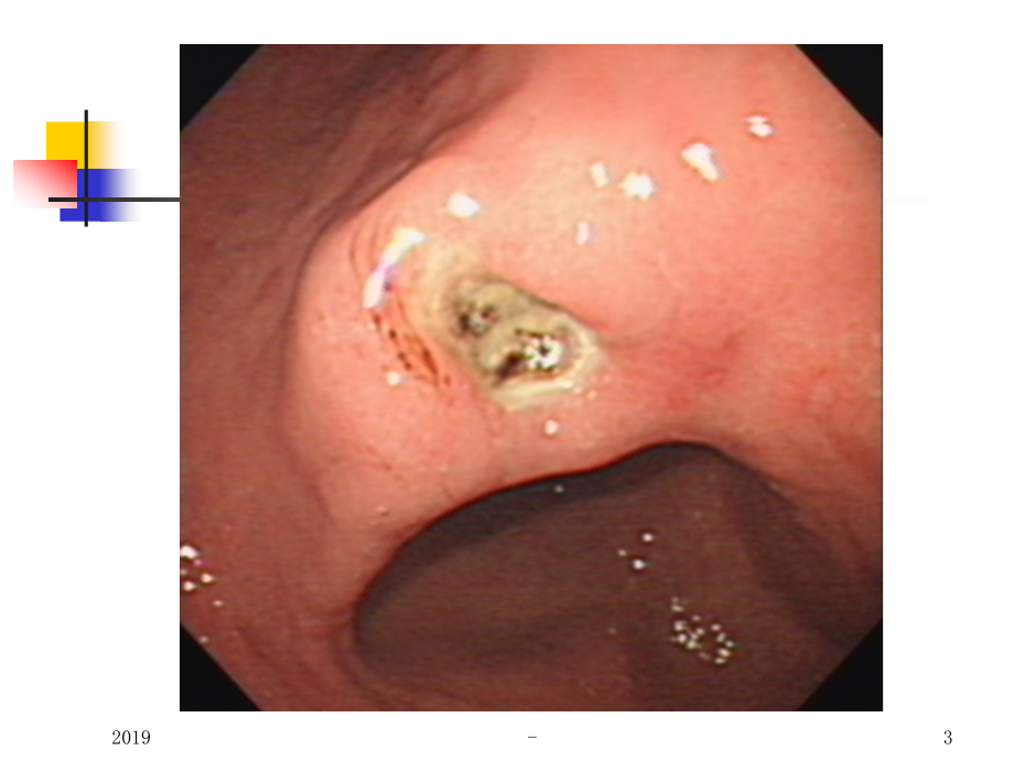 四川大学华西医院消化性溃疡讲稿ppt课件课件ppt_第3页