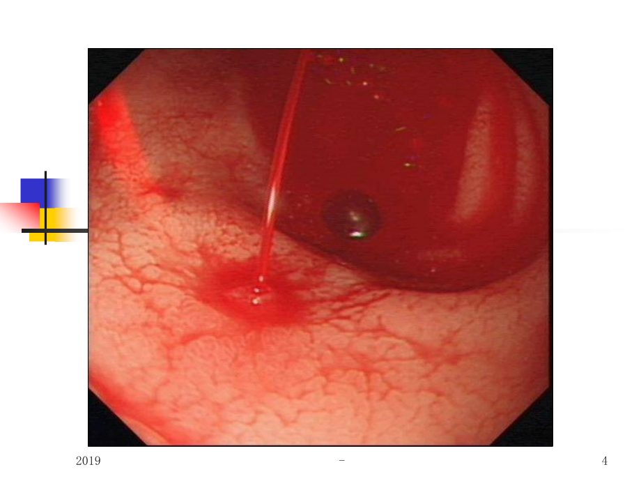 四川大学华西医院消化性溃疡讲稿ppt课件课件ppt_第4页
