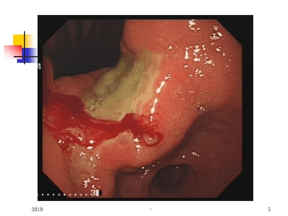 四川大学华西医院消化性溃疡讲稿ppt课件课件ppt_第5页