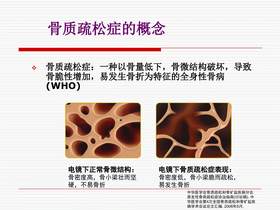 糖皮质激素性骨质疏松症的诊治进展(GIO_第3页