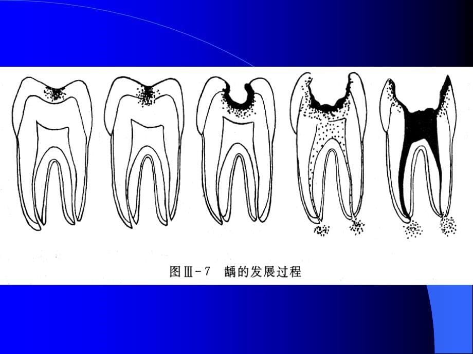 牙体牙髓病75939_第5页