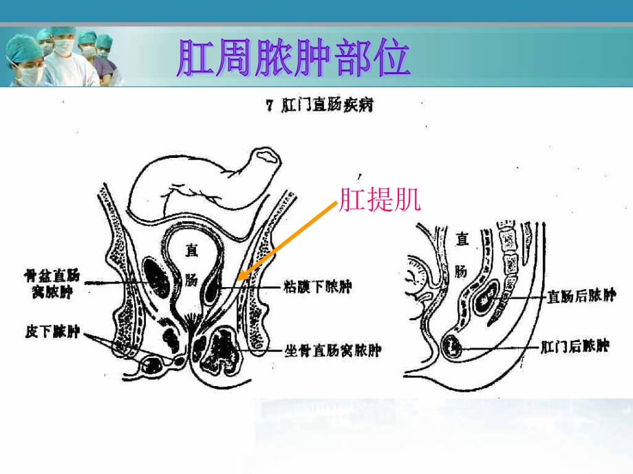 肛痈教学课件ppt课件课件ppt_第5页