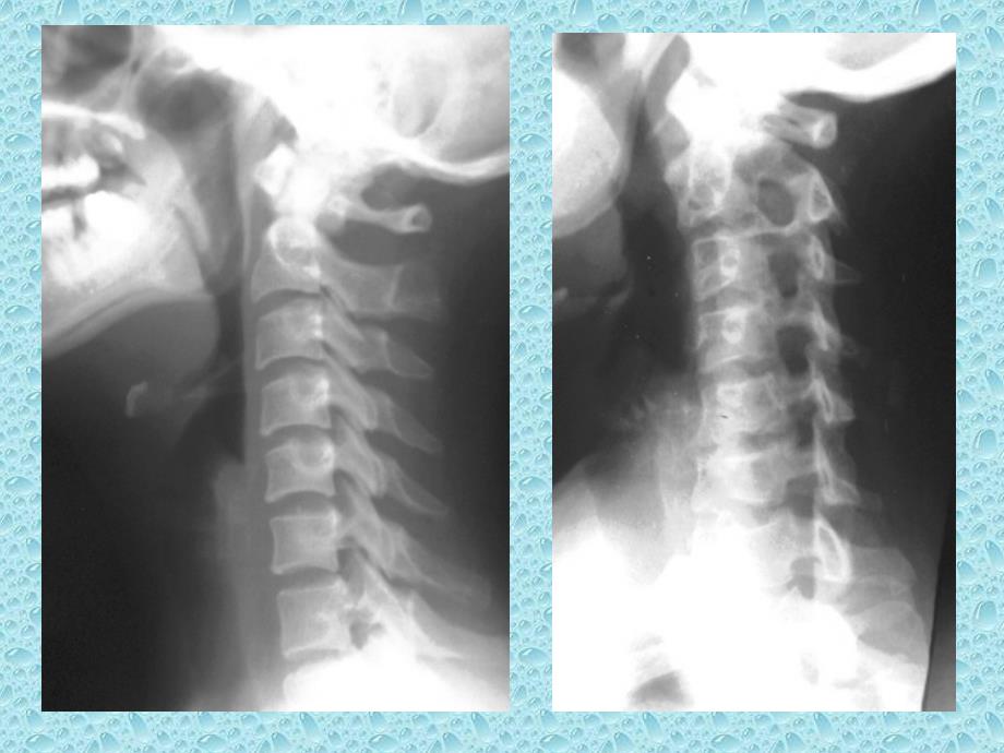 颈椎病(1)课件ppt_第3页