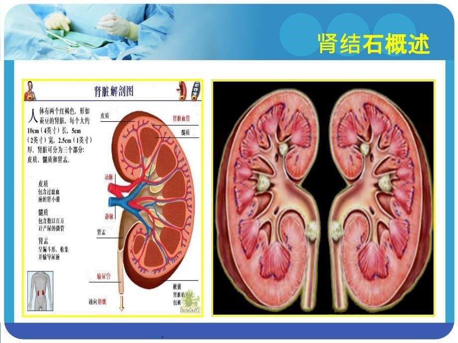 经皮肾镜碎石取石术后护理查房杨华春ppt课件_第5页