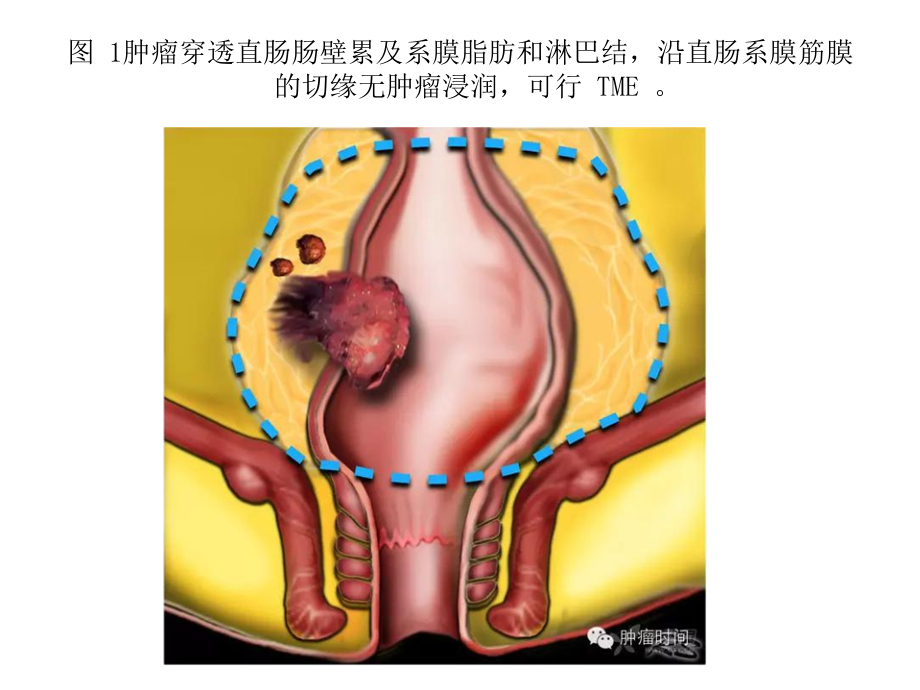 直肠癌诊疗图解ppt课件课件ppt_第3页