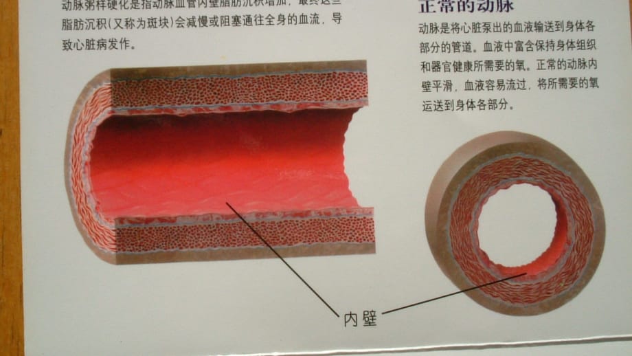 冠心病健康教育84370_第4页