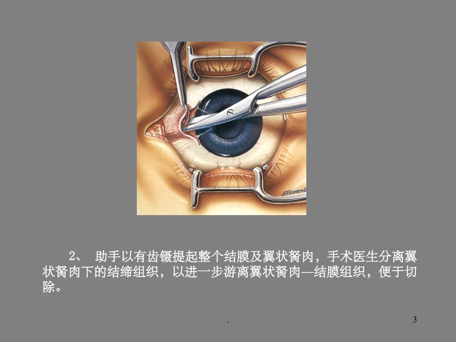 翼状胬肉的手术ppt课件_第3页