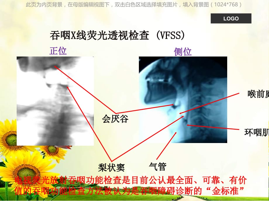 吞咽困难护理查房ppt课件课件ppt_第5页