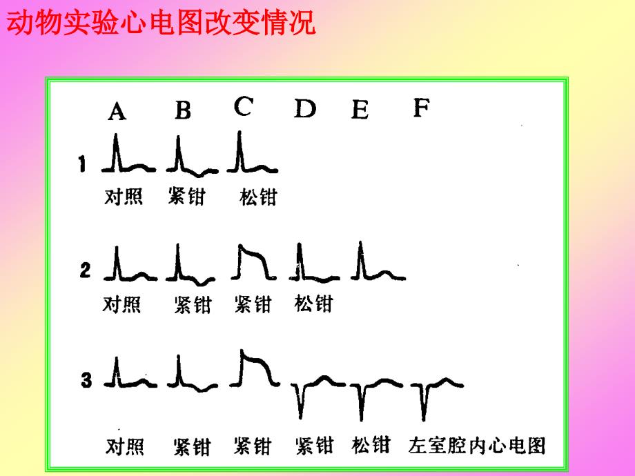 急性心肌梗死心电图演变课件ppt_第3页