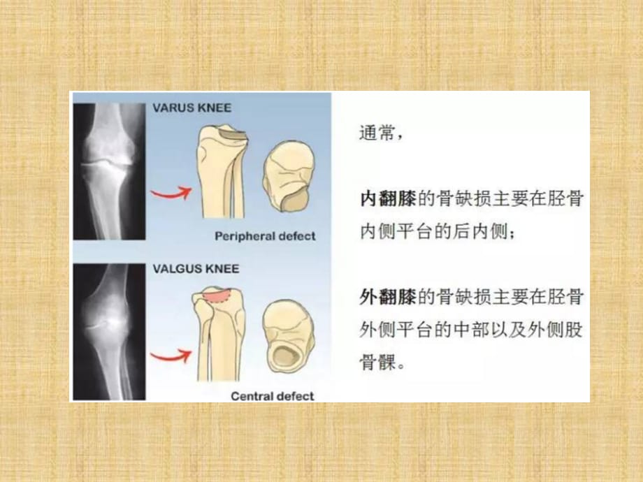 全膝关节置换中骨缺损的分型和处理精编版_第2页