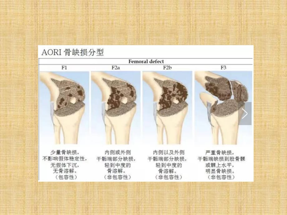 全膝关节置换中骨缺损的分型和处理精编版_第5页