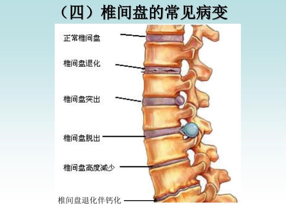 小讲课腰椎间盘突出课件ppt_第5页