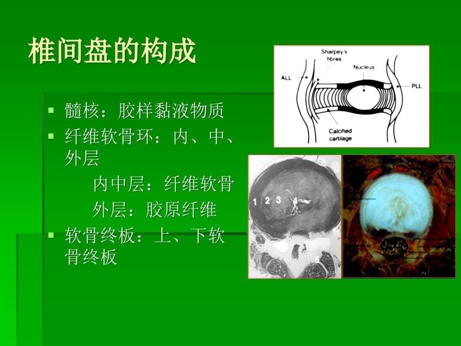 椎间盘突出的影像学诊断PPT课件_第5页