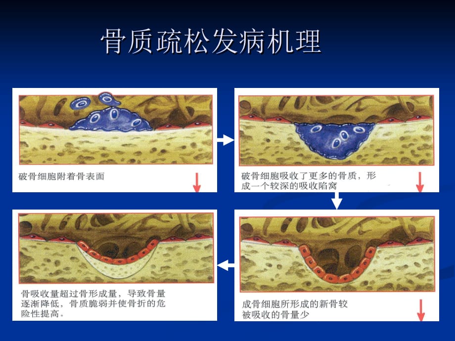 原发性骨质疏松症诊治指南课件ppt_第3页