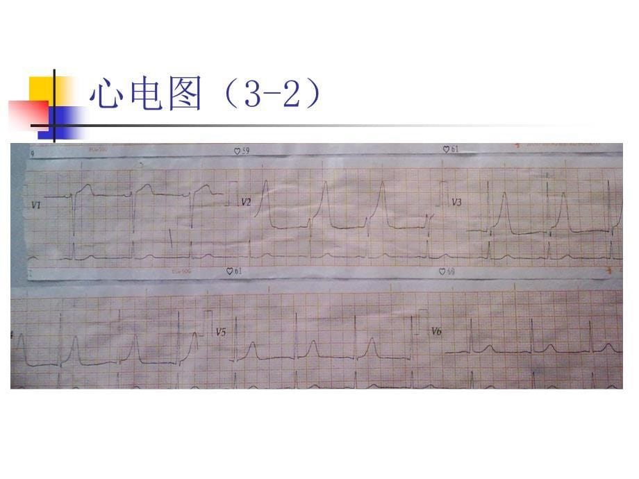 心肌梗死病例介绍课件ppt_第5页