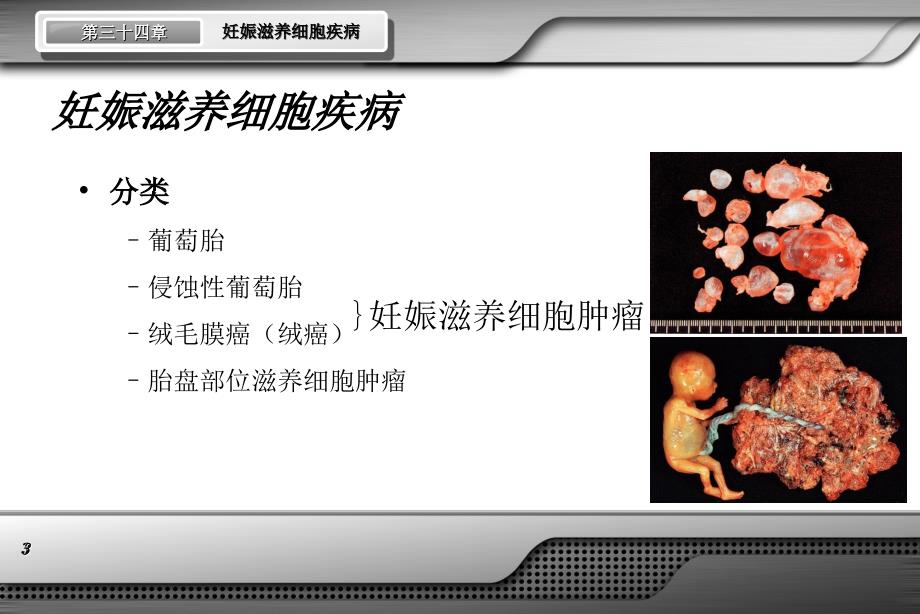 妇产科学配套第七版妊娠滋养细胞疾病课件课件ppt_第3页