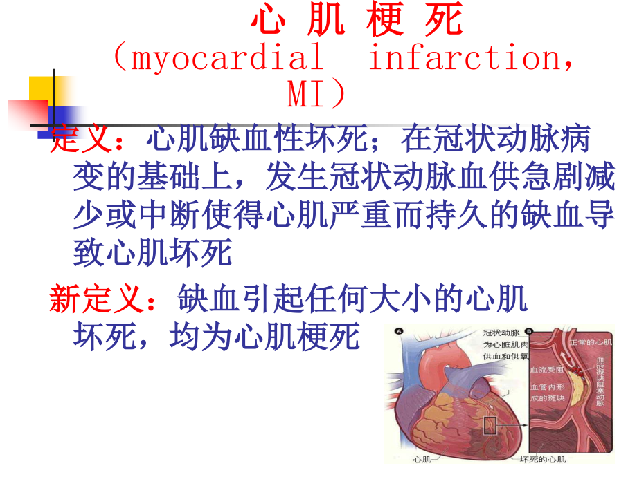 心肌梗死课件课件ppt_第3页