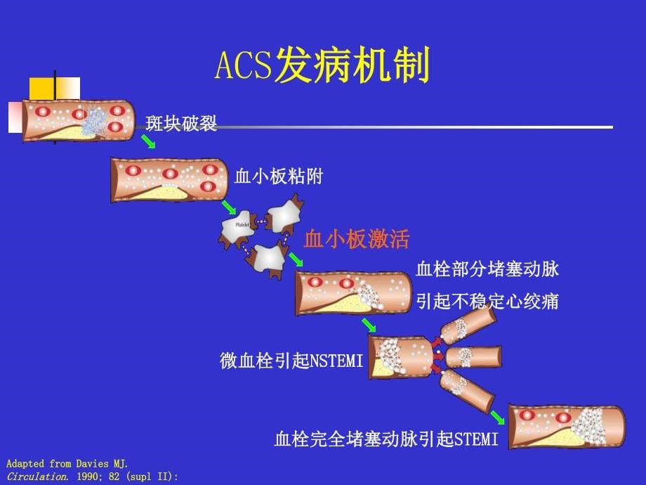 心肌梗死课件课件ppt_第5页