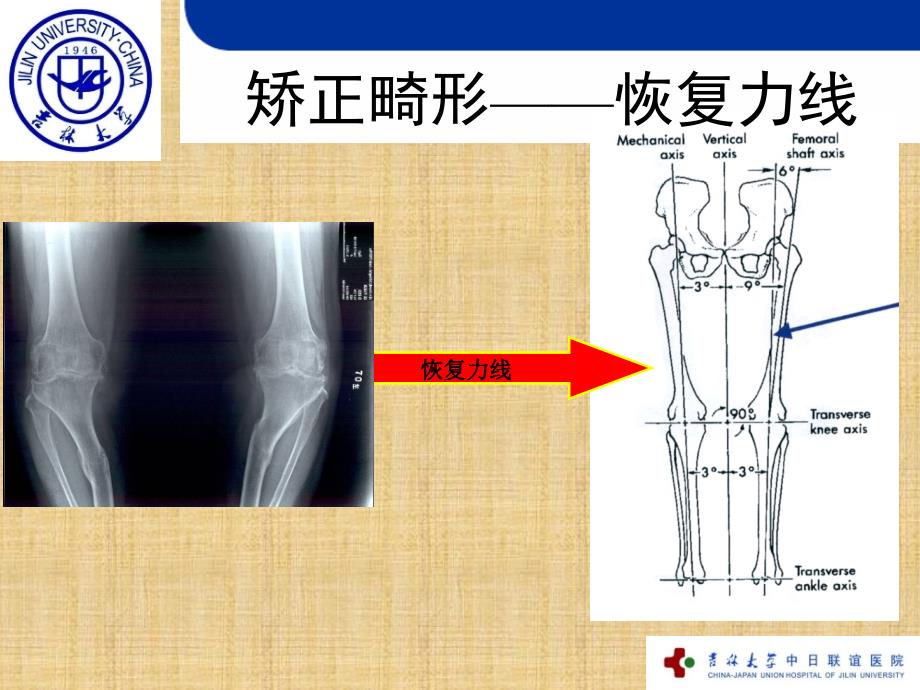 全膝关节置换的截骨原则精编版_第4页