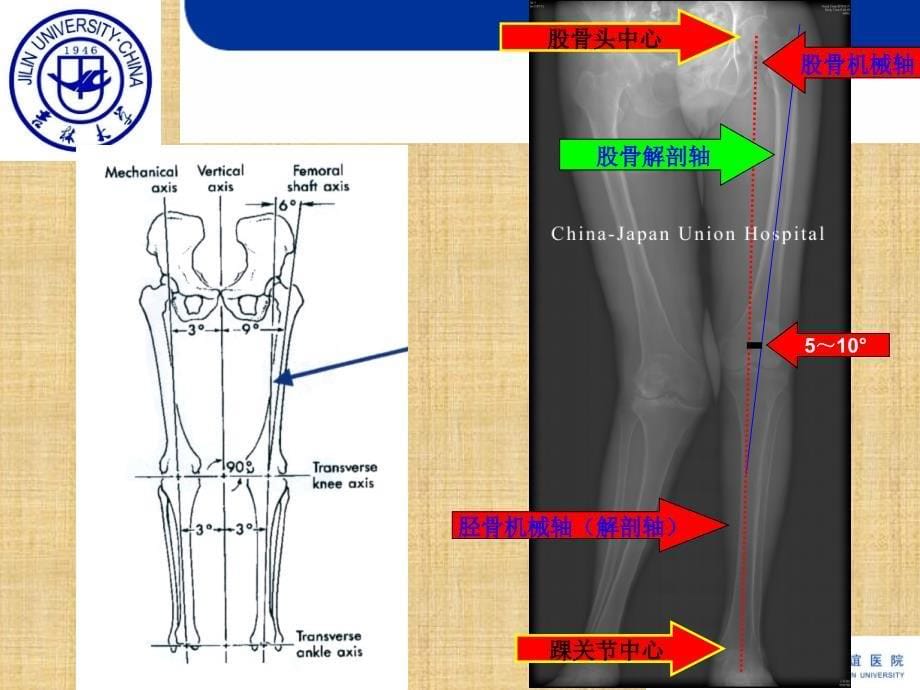 全膝关节置换的截骨原则精编版_第5页