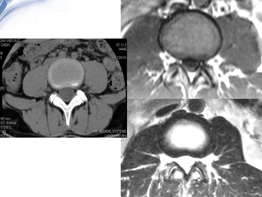 腰椎影像解剖及常见病变PPT课件_第4页
