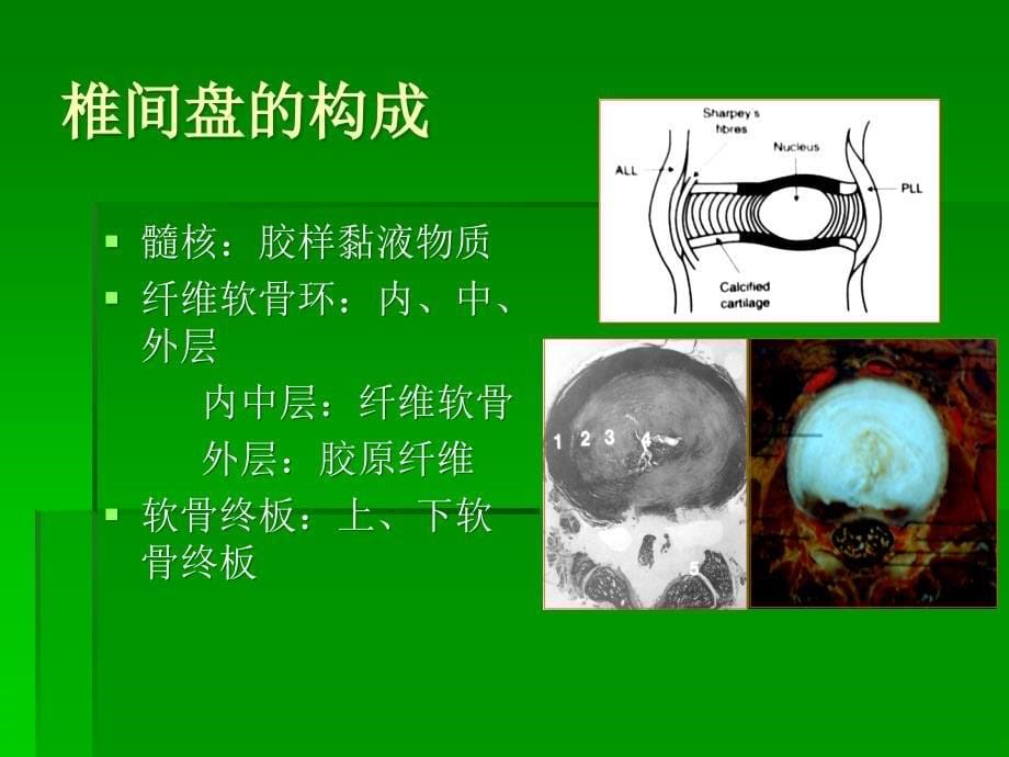 椎间盘突出的影像学诊断课件ppt_第5页