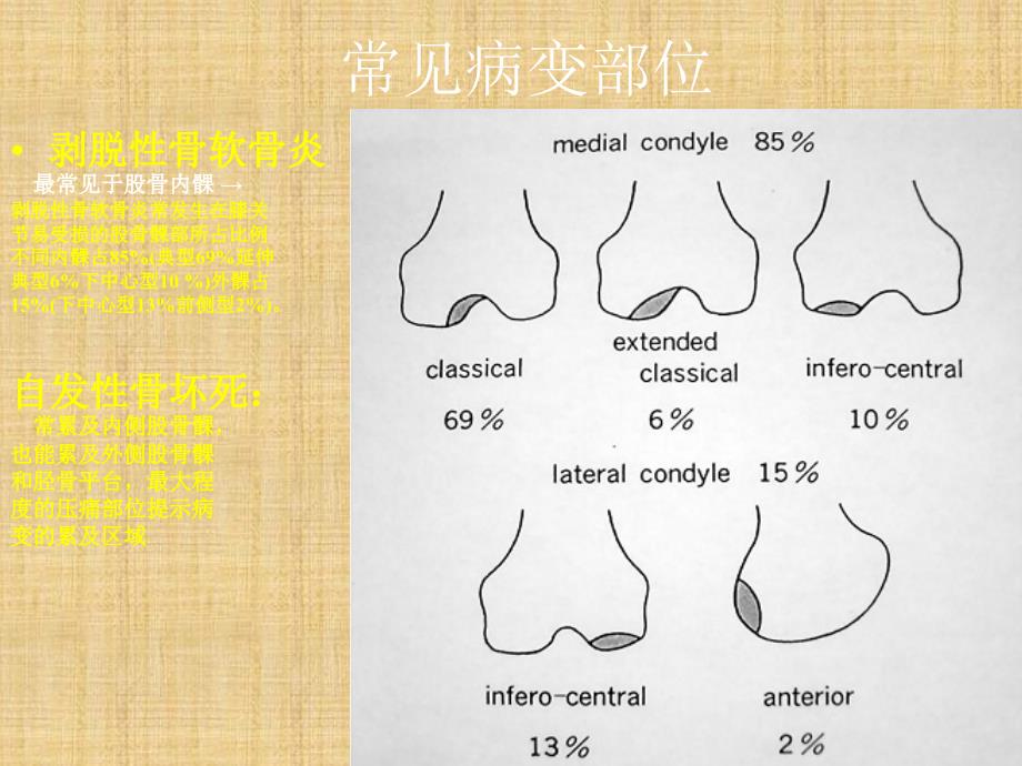 成人原发性膝关节骨坏死与剥脱性骨软骨炎精编版_第4页