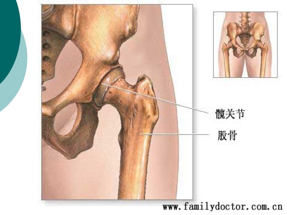 全髋关节置换病人的护理课件ppt_第4页