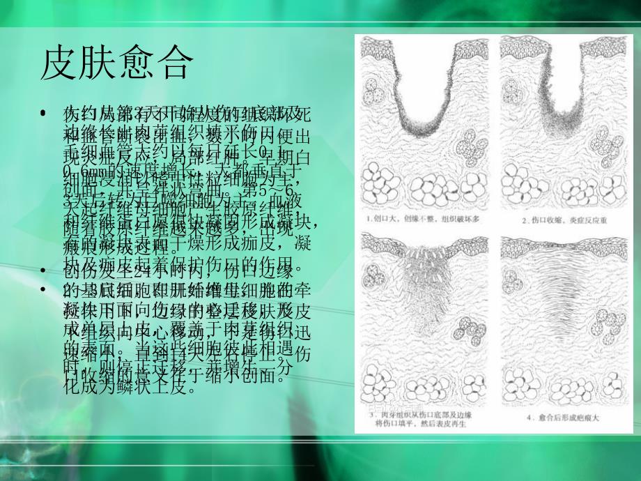 皮肤肌肉骨的愈合课件ppt_第2页