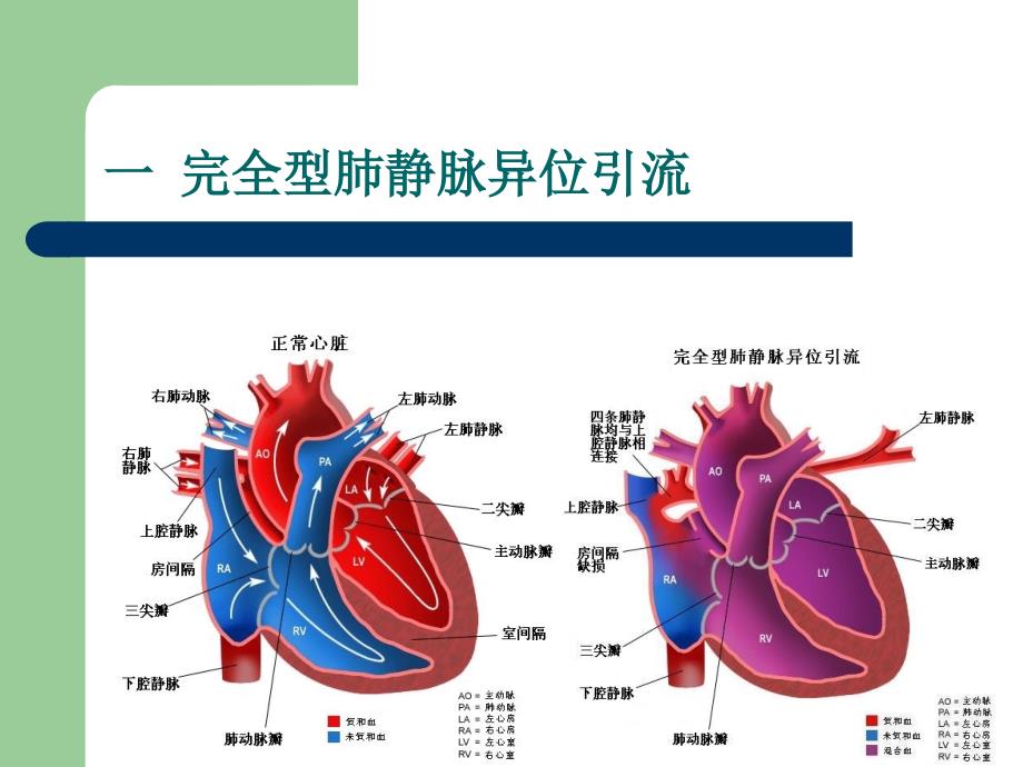 肺静脉异位引流课件ppt_第4页