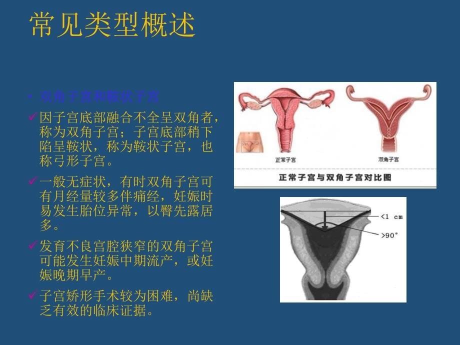 子宫发育异常天坛医院课件ppt_第5页