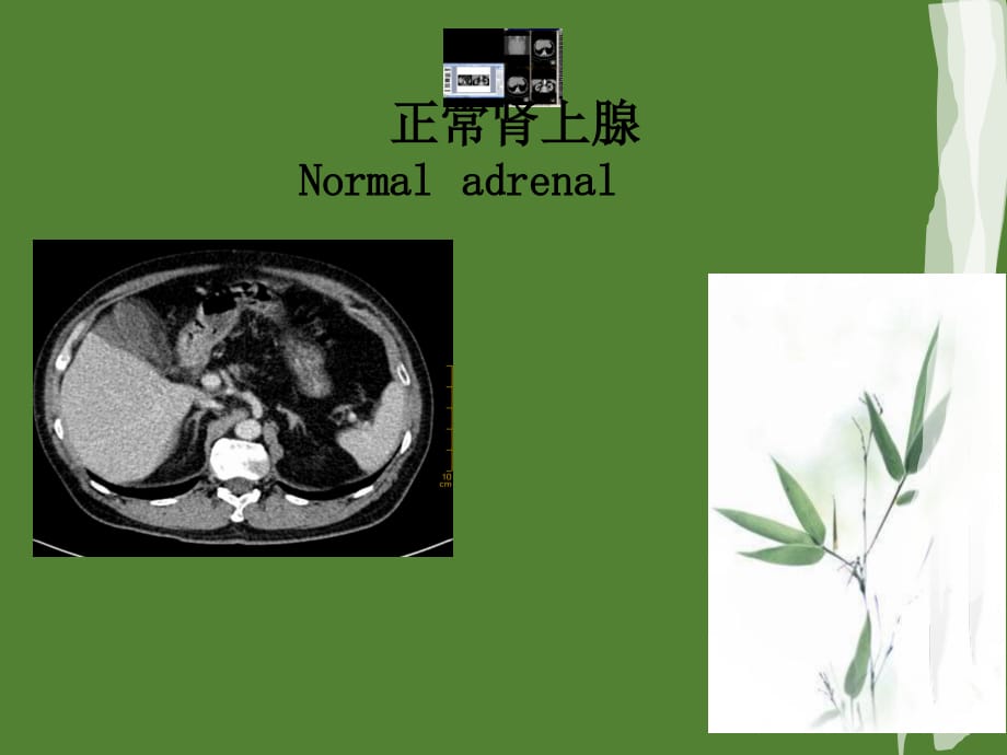 肾上腺静脉分段取血在原发性醛固酮增多症中的应用课件ppt_第2页