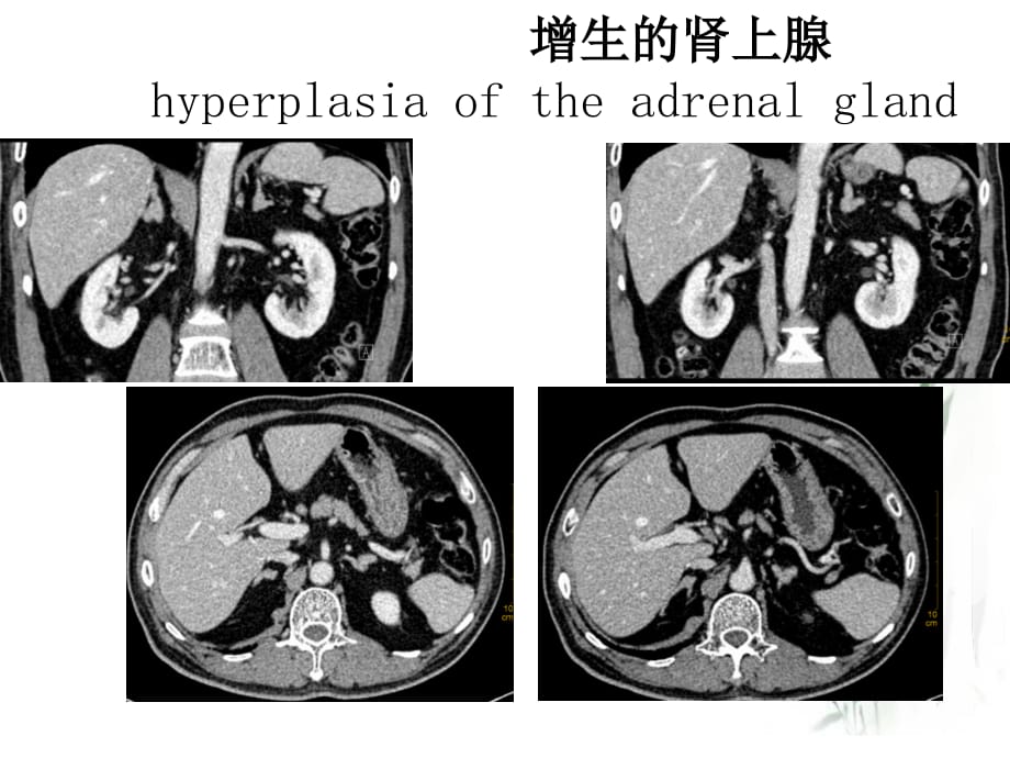 肾上腺静脉分段取血在原发性醛固酮增多症中的应用课件ppt_第4页