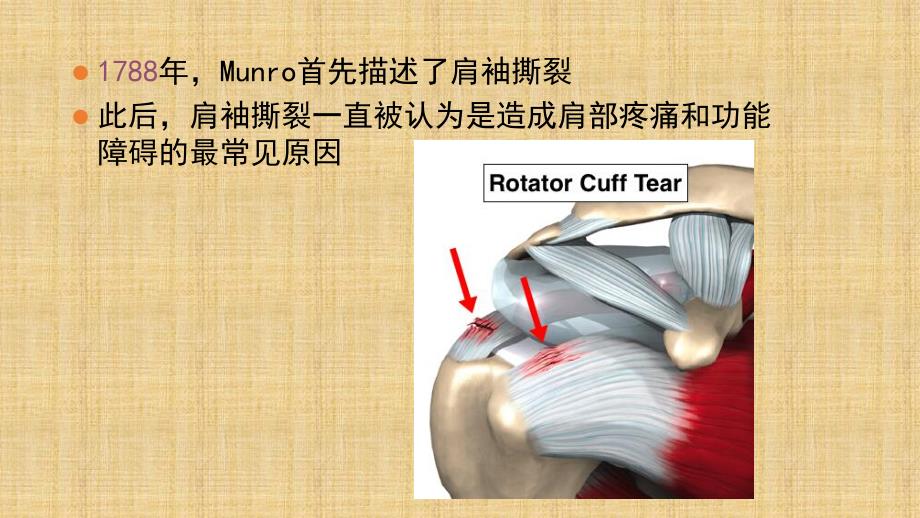 肩胛苍苍-运动创伤——肩袖损伤分型、诊断以及缝合方法精编版_第4页